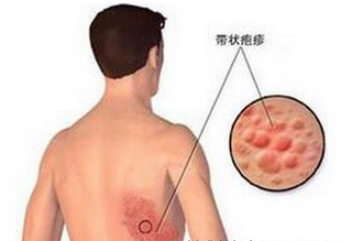 哈尔滨皮肤病医院：带状疱疹要结合这两种医治办法！