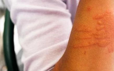 哈尔滨肤康皮肤病医院哪些要素会诱发荨麻疹？
